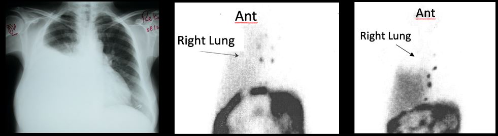 Hepatic Hydrothorax on Peritoneal Scintigraphy